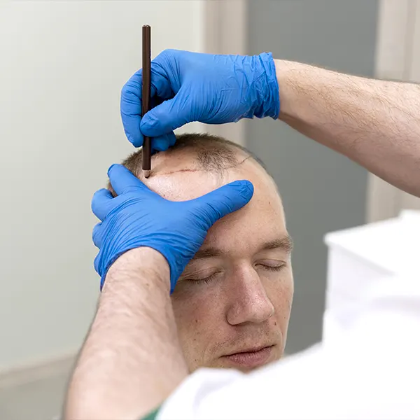 Img-clinica-estetica-bogota-Servicio-Implante_Capilar